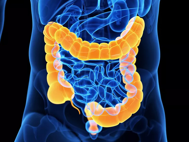 Colon Cancer