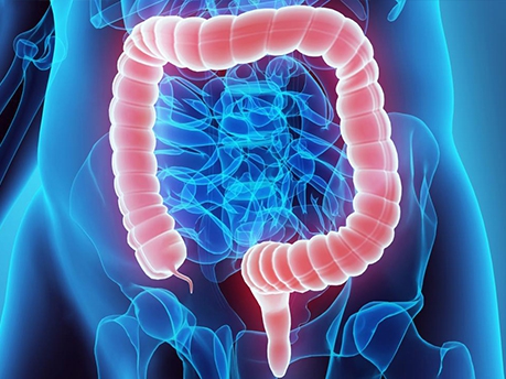 Ung thư đại tràng