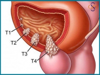 Tìm hiểu ung thư tiền liệt tuyến
